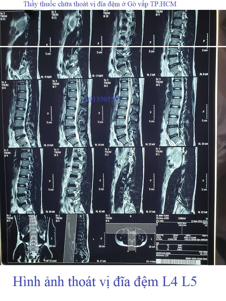 Hình ảnh thoát vị đĩa đệm 